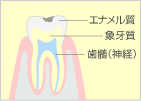 軽度の虫歯（C1）