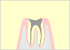 最重度の虫歯（C4）