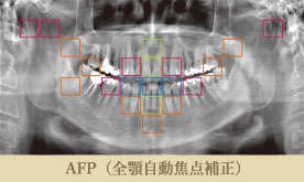 AFP（全顎自動焦点補正）