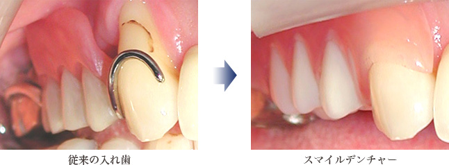 従来の入れ歯とスマイルデンチャー