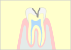 中度の虫歯（C2）