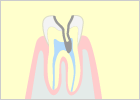 重度の虫歯（C3）
