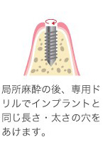 インプラントを埋め込む手術をおこない、その後の管理をしていきます