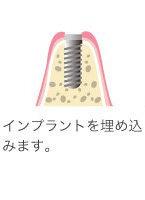 インプラントを埋め込む手術をおこない、その後の管理をしていきます