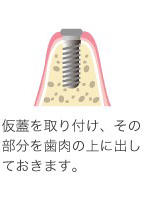 インプラントを埋め込む手術をおこない、その後の管理をしていきます