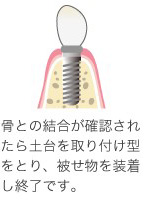 インプラントを埋め込む手術をおこない、その後の管理をしていきます