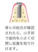 インプラントを埋め込む手術をおこない、その後の管理をしていきます