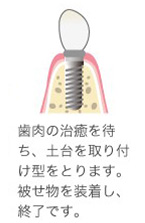 インプラントを埋め込む手術をおこない、その後の管理をしていきます