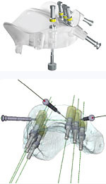 綿密な治療計画とGuided Surgery