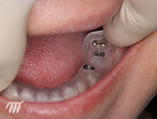 写真：surgical guideを装着