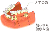 インプラント以外