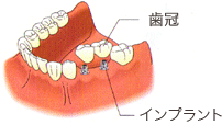 インプラント