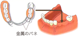 インプラント以外