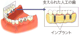 インプラント