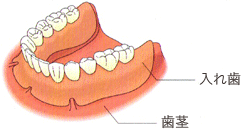 インプラント以外