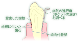 歯周病