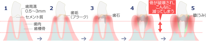 歯周病の進行の様子