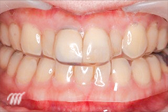 3DS除菌治療の写真