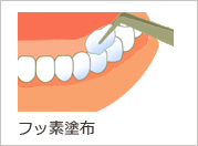 フッ素塗布