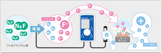 フッ素イオン導入法の仕組み